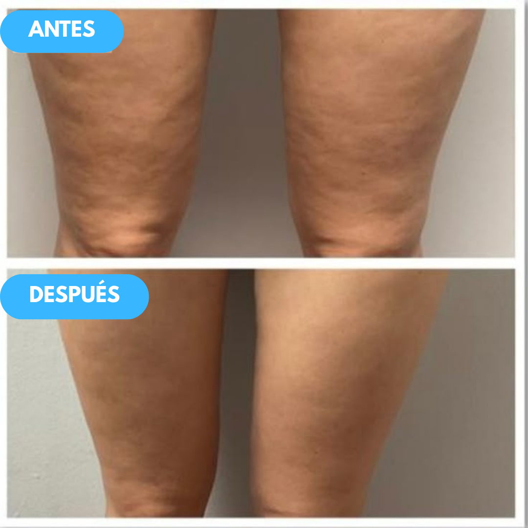 1+1 GRATIS | Get Dreamy™ - Crema reafirmante exprés para piernas