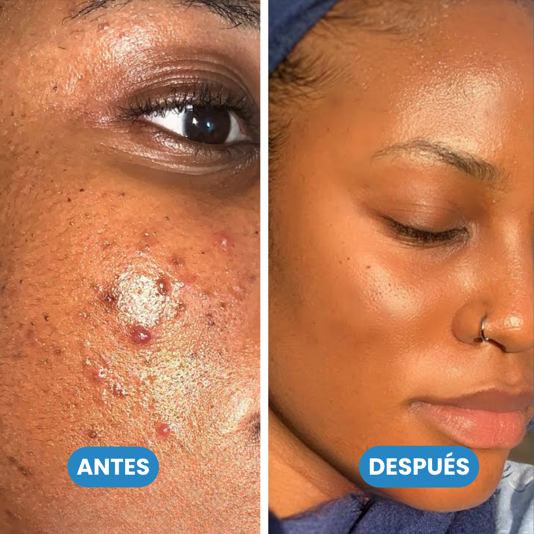 Jiyu - Parches coreanos eliminadores de manchas