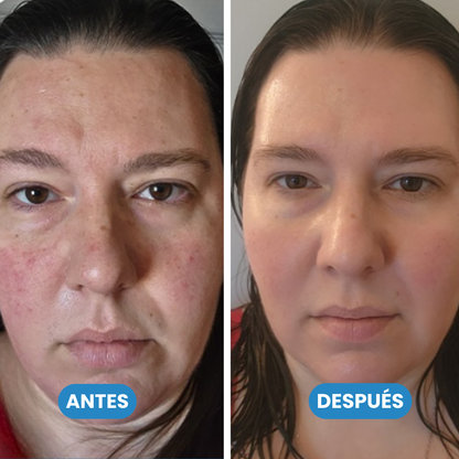 Jiyu - Parches coreanos eliminadores de manchas