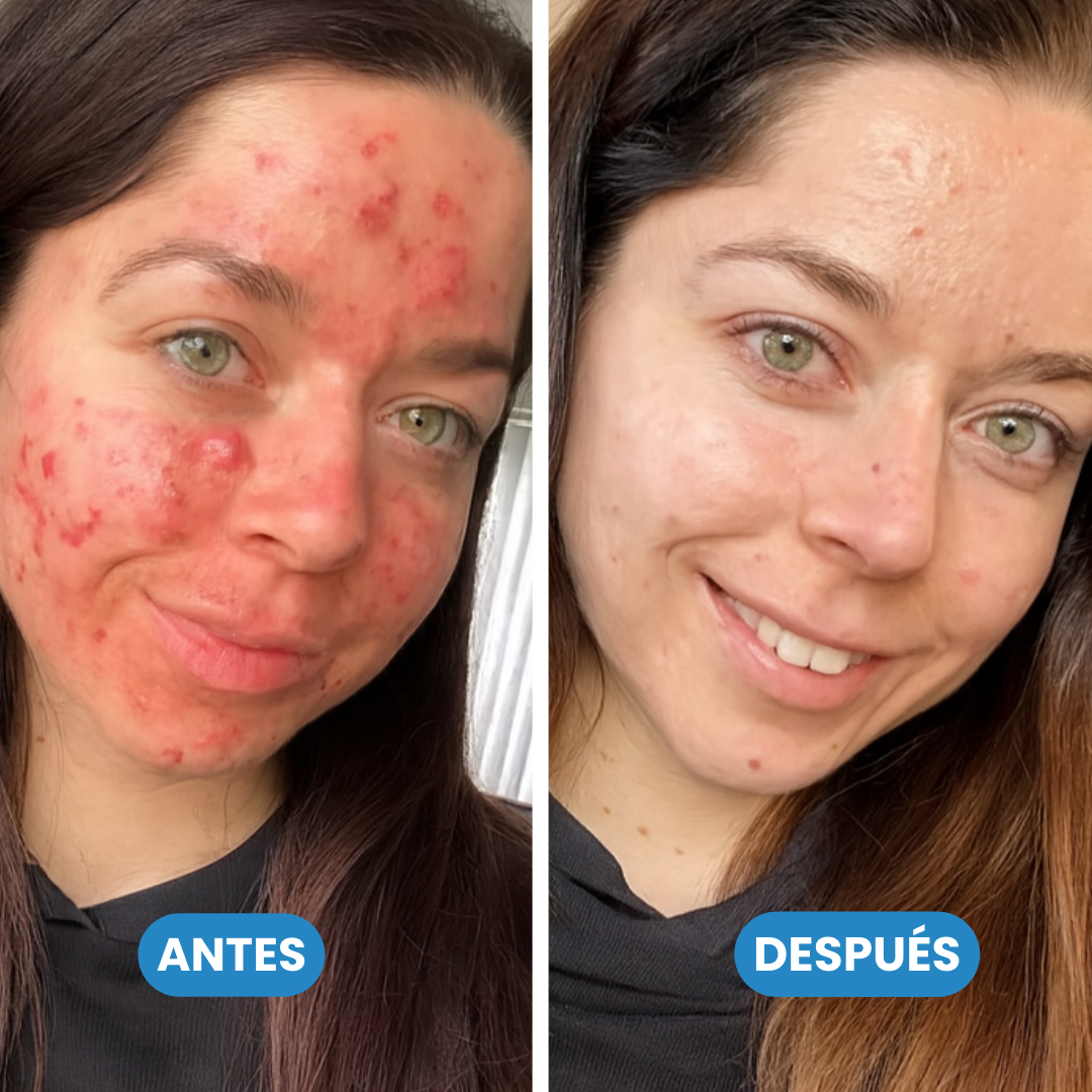 Sovana Bee - Crema para eliminar verrugas con Veneno de Abeja