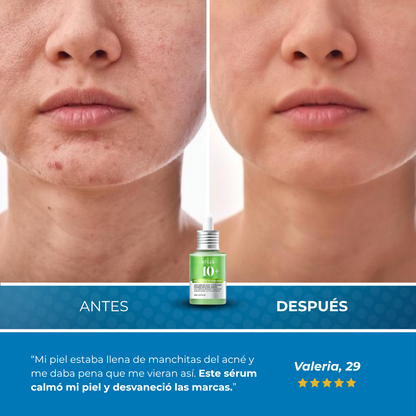 Sovana Anua - Sérum para eliminar tus manchas de acné en 6 días