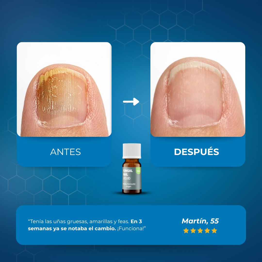 Sanorys Fung - Líquido para eliminar hongos de las uñas